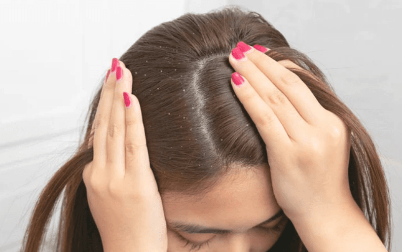 scalp-conditions