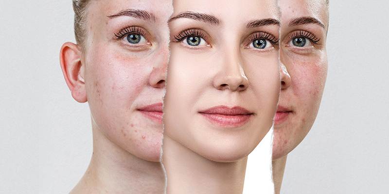 plastic-surgery-for-acne-scars