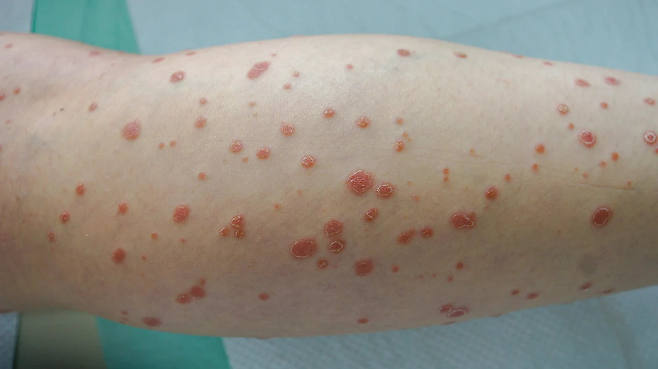 Which Clinic Offers the Best Fungal Infection Treatment in Greater Noida West?