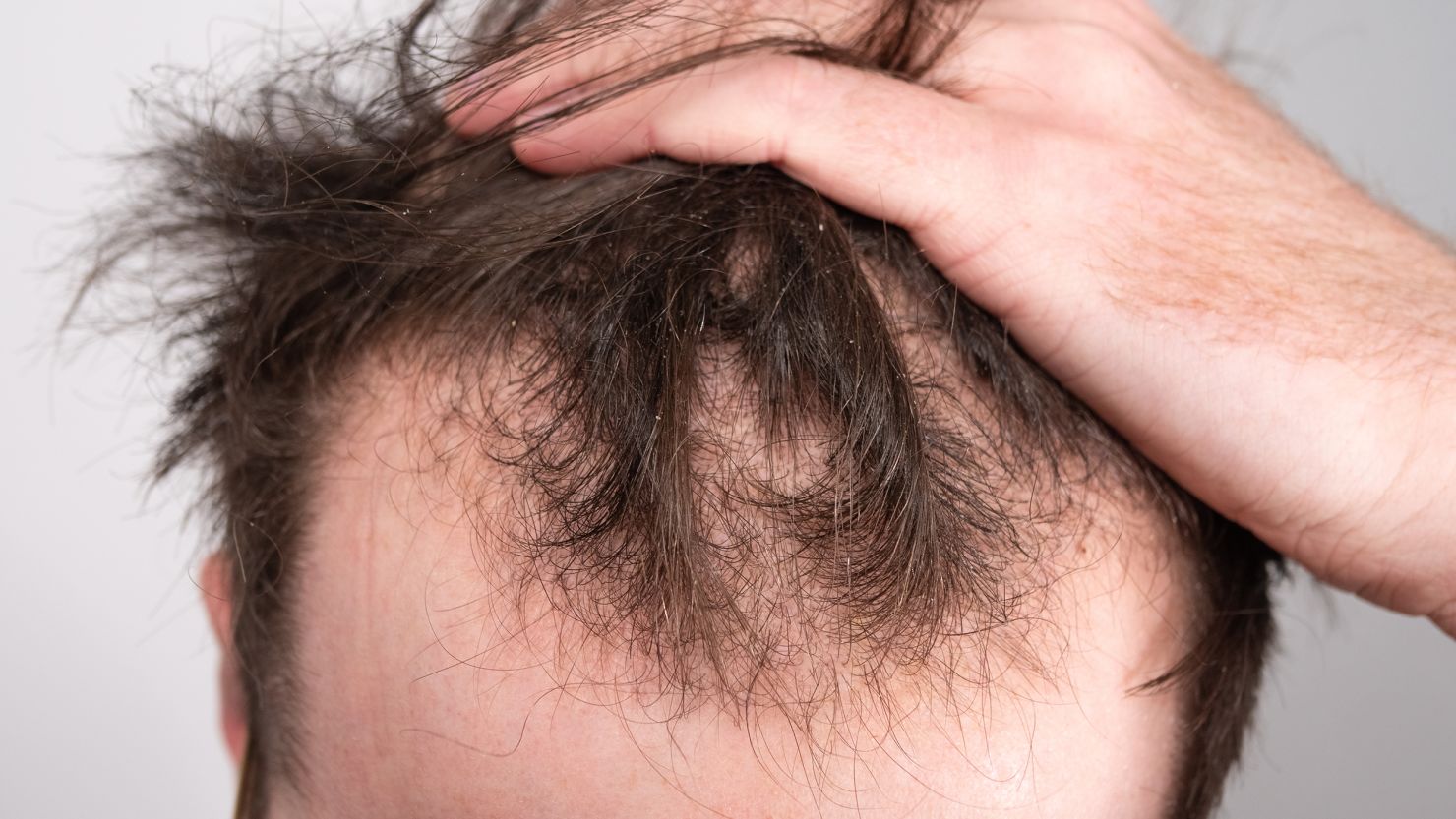 No. 1 Hair Loss Treatment in Noida