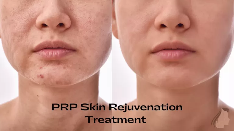 Best PRP Treatment for Face in Noida