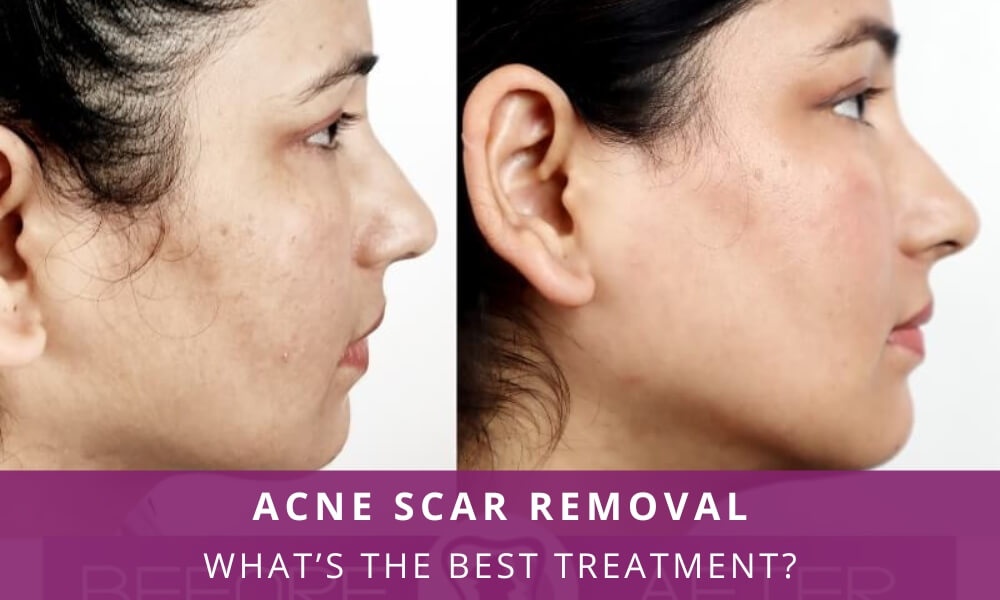 Plastic Surgery for Acne Scars in Gaur City