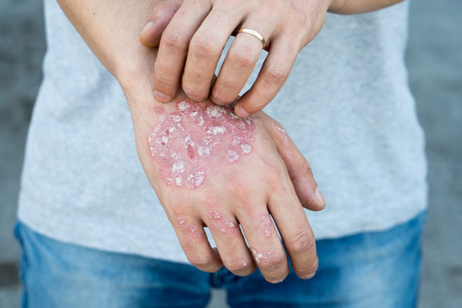 best doctor for psoriasis in Noida