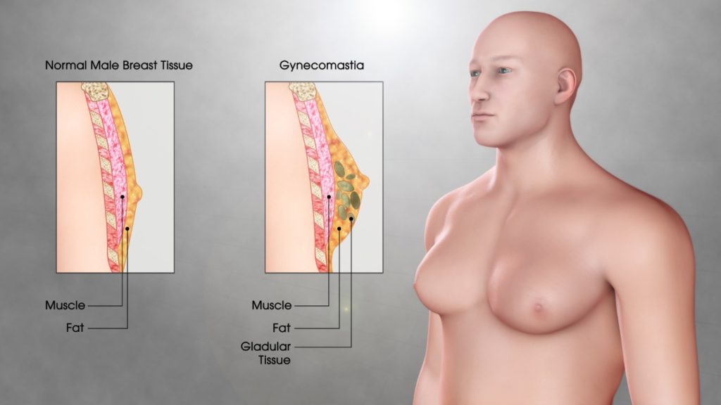 Best Gynaecomastia Correction Doctor in Noida