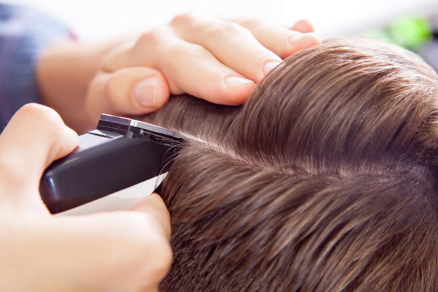 Best Hair Loss Treatment in Noida