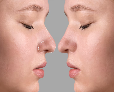 Best Rhinoplasty Surgeon in Gaur City
