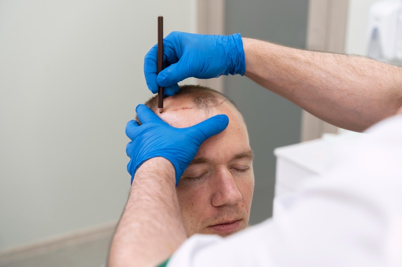 Best Hair Transplant Clinic Near Noida Extension