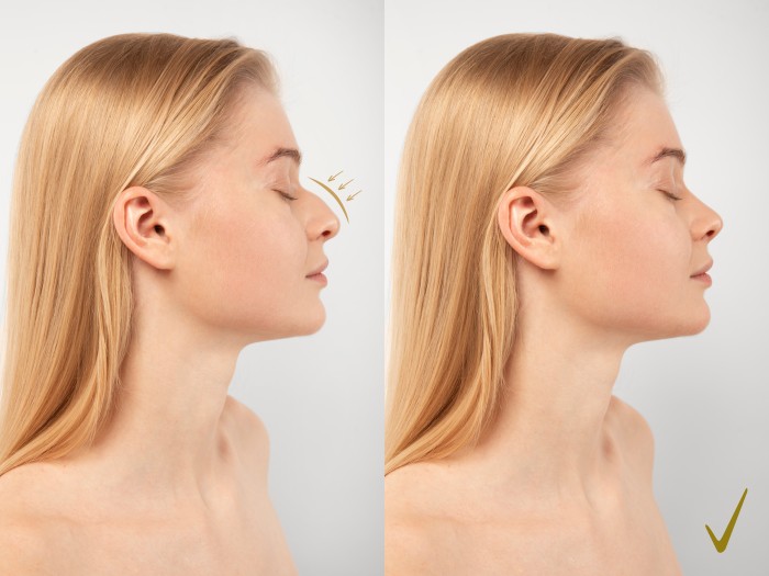 Best Rhinoplasty Surgeon In Noida Extension