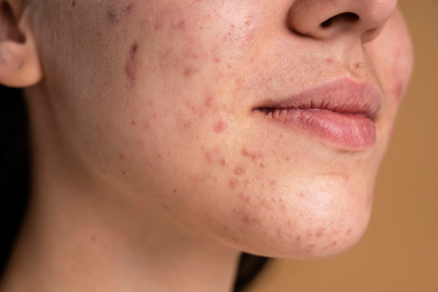 Best acne scars doctors in greater noida west