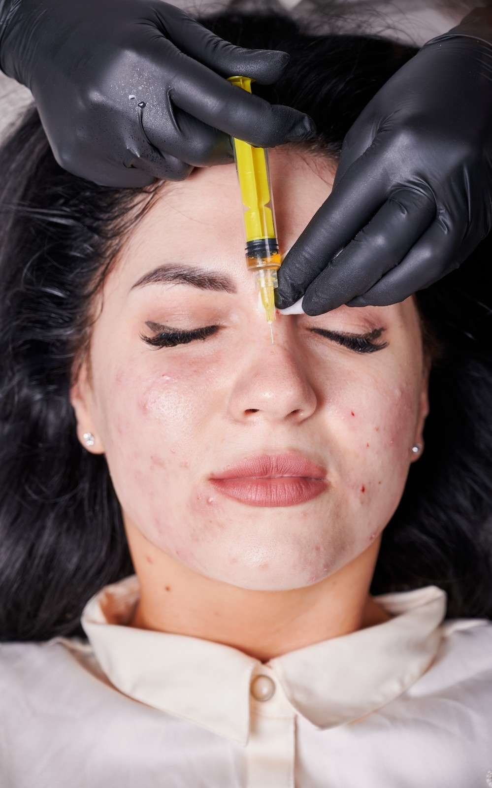 Plastic Surgery for Acne Scars in Noida