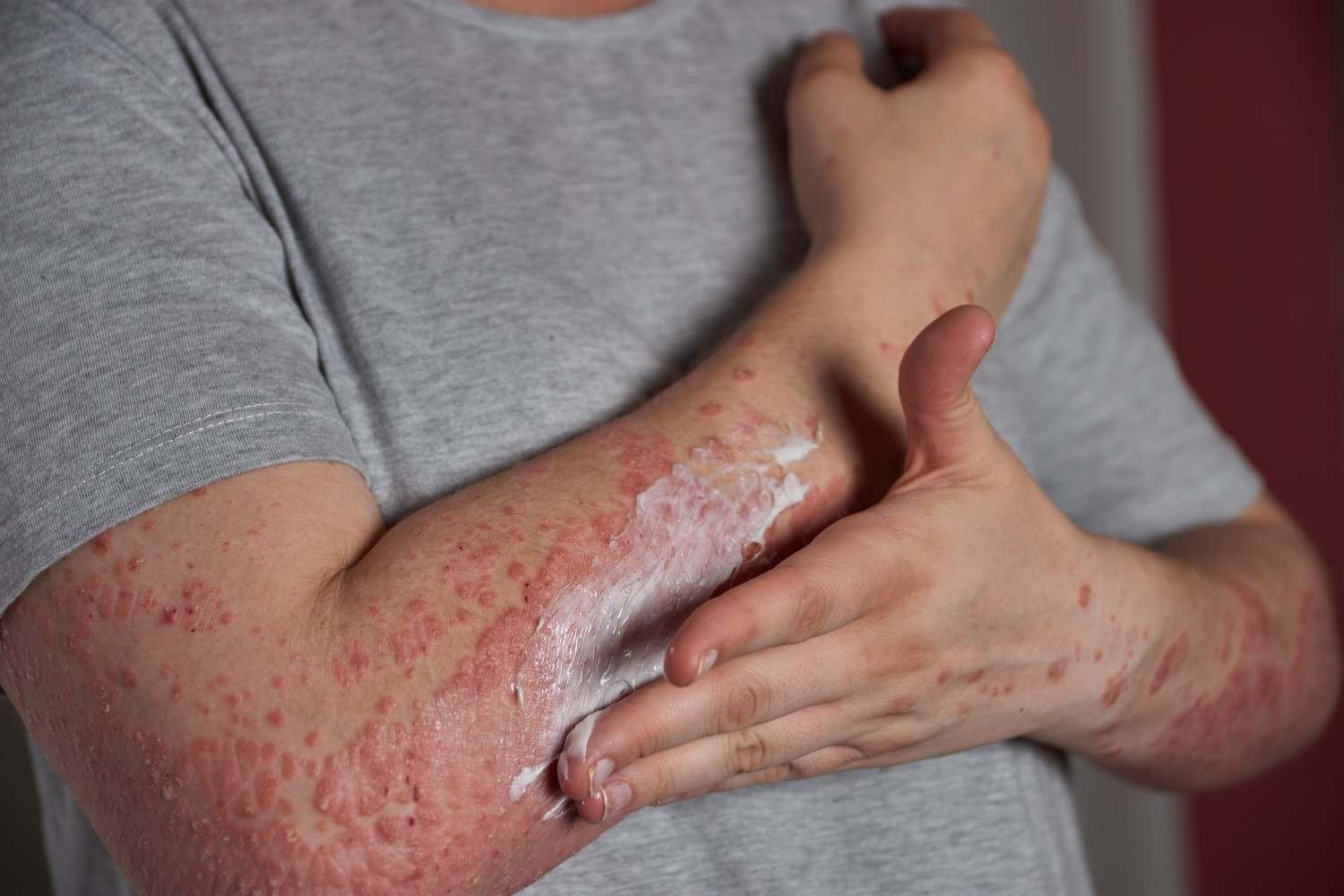 Fungal Infection Doctor in Noida