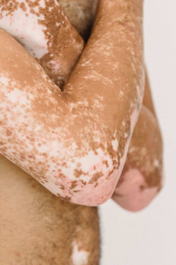 Psoriasis Treatment in Noida
