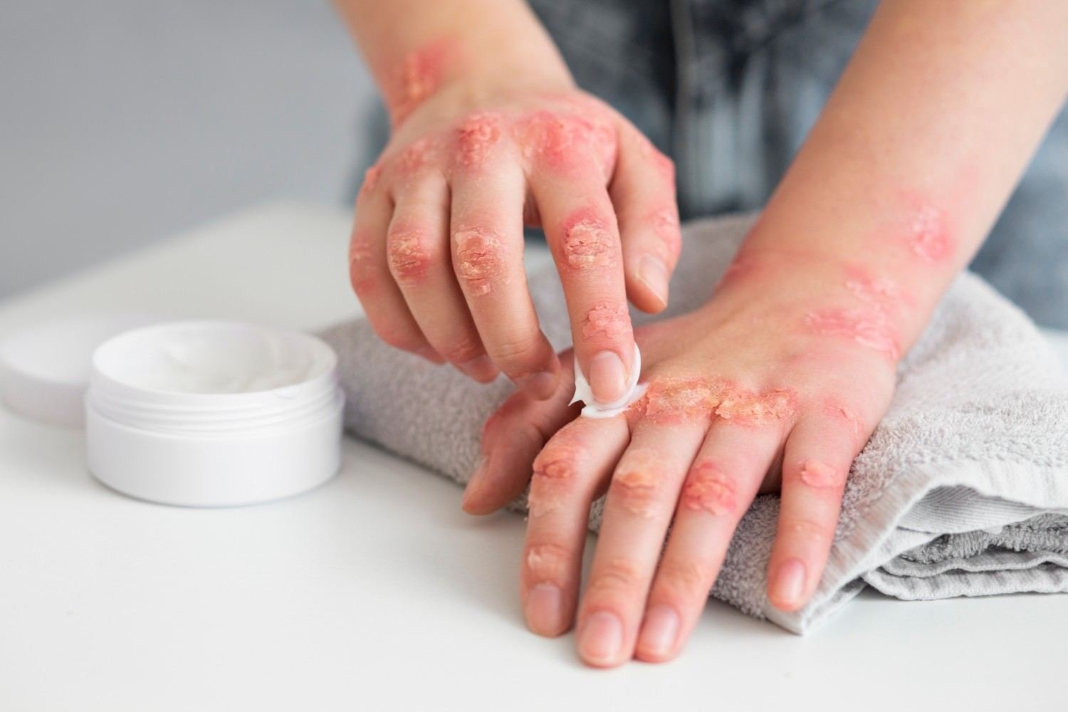 Eczema Treatment in Noida