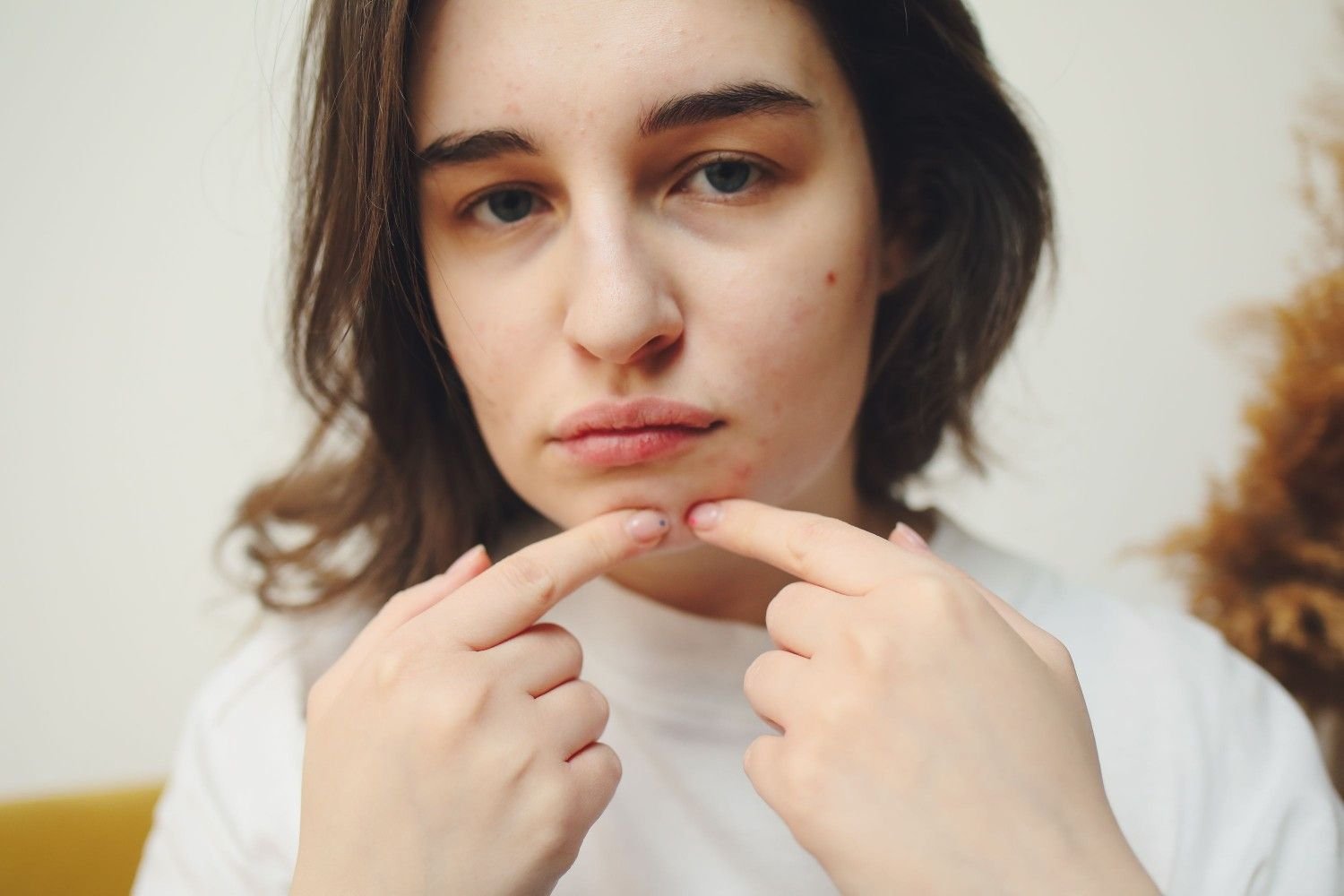 Acne Scar Treatment in Noida